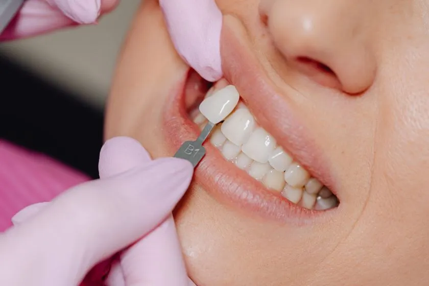 Carillas-dentales-ibague