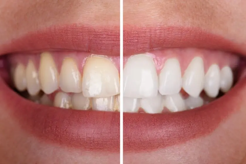 Resultados de blanqueamiento dental profesional antes y después en Ibagué